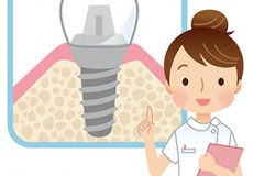 術後が大事! インプラント後の5つの注意点
