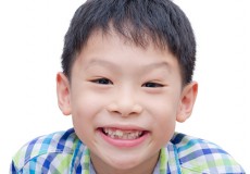 小さい子でも大丈夫? 子供のインプラント手術について