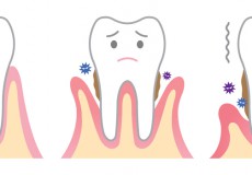 歯周病を引き起こす4つの因子とは?