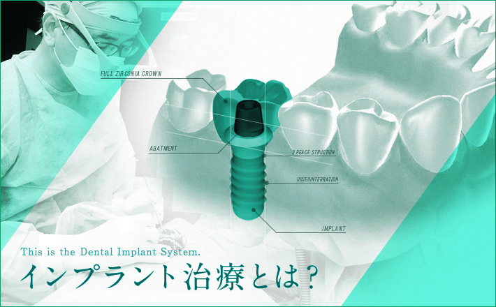 インプラント治療とは