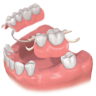 部分入れ歯
