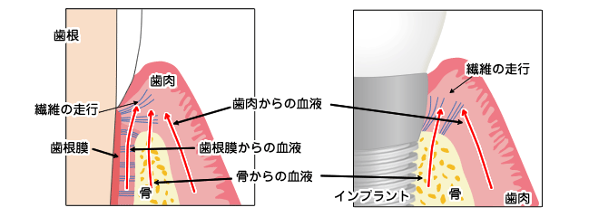 天然歯とインプラントの違い